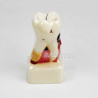 Dental Study Teaching Model Teeth Implant Model  