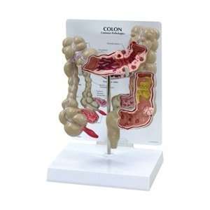 Colon Anatomy Model w/ common pathologies  Industrial 
